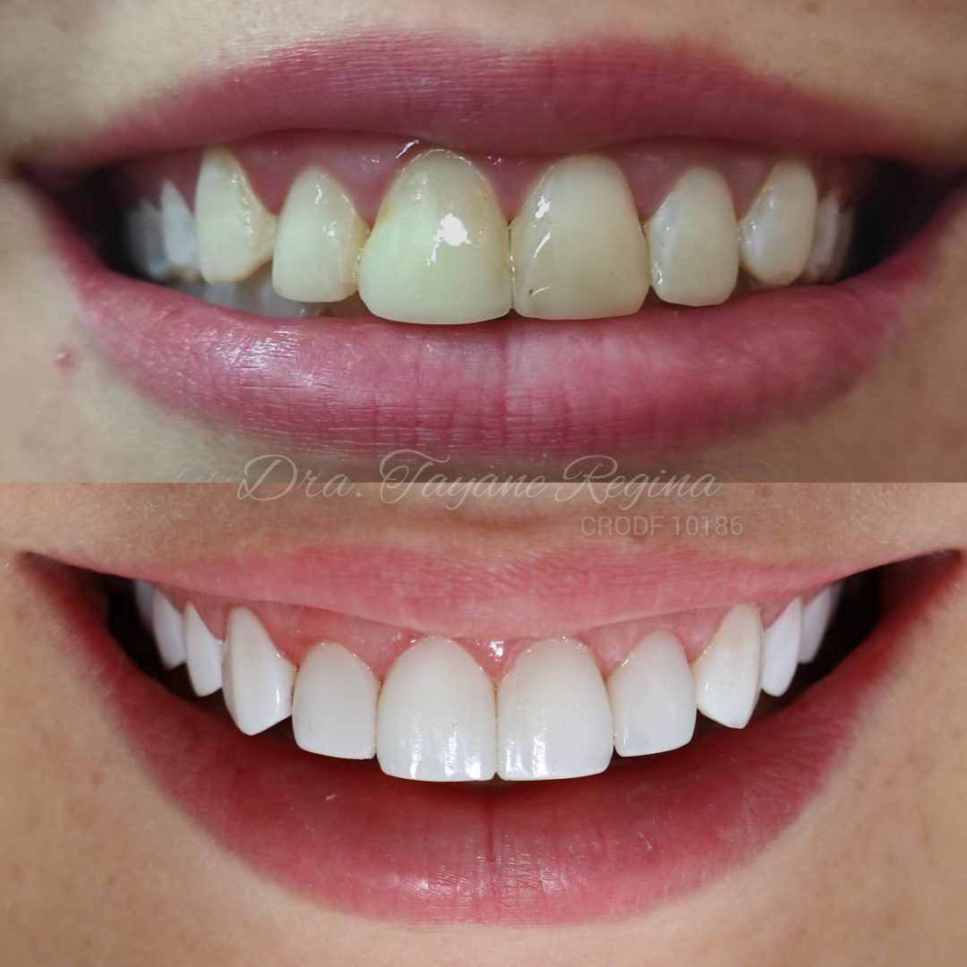 Clínica Odontológica Especializada em Estética - Faceta de resina antes e depois